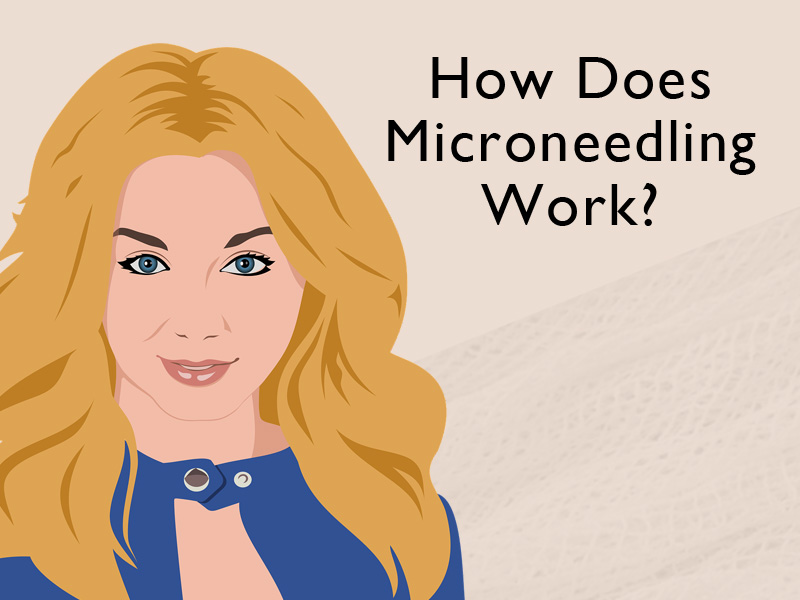 lady with lovely skin to illustrate the effects of microneedling